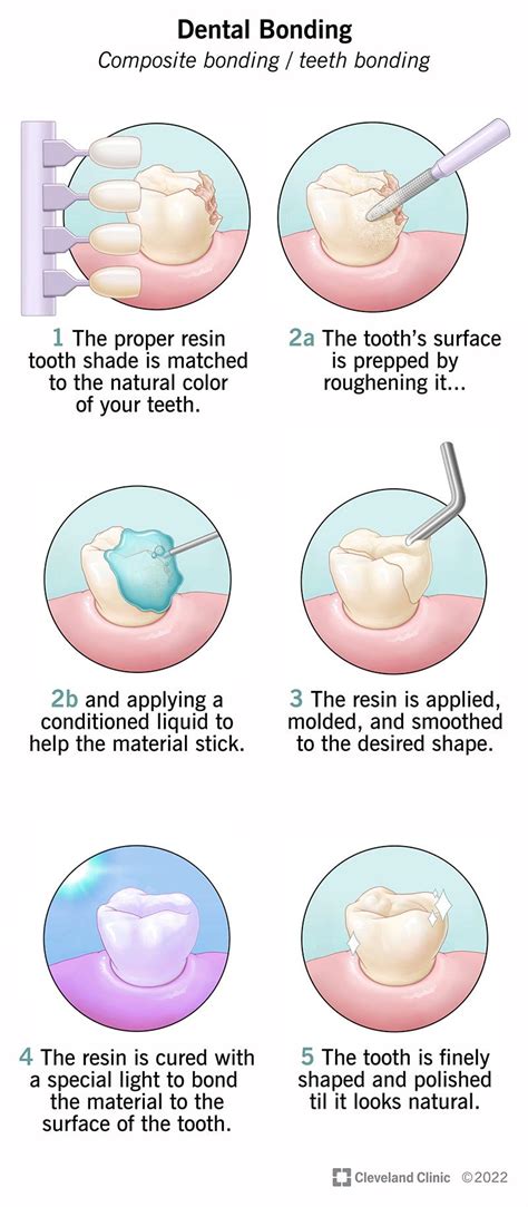 Bonding Tooth Procedure