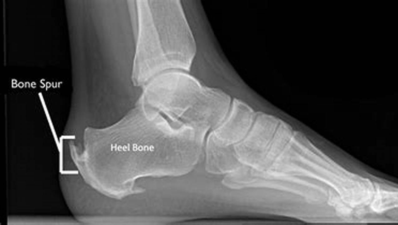 Bone Spur on Achilles