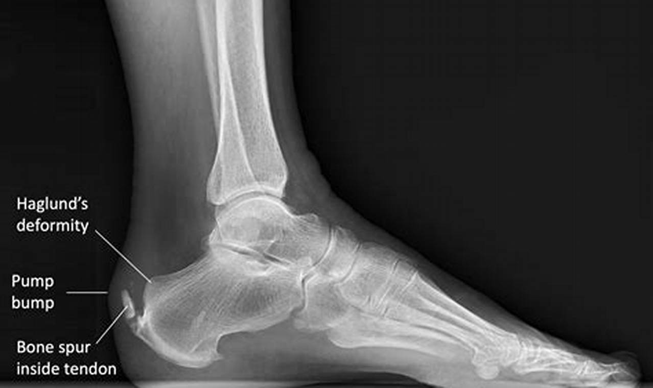 Bone Spur Under Achilles