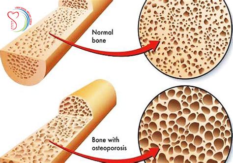 Bone Density For Dental Implants
