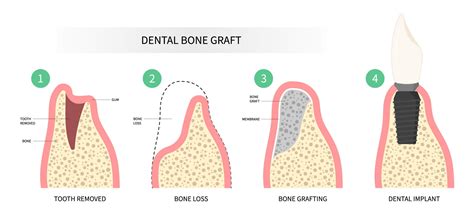 Bone Graft Healing