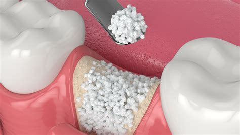 bone graft in dental