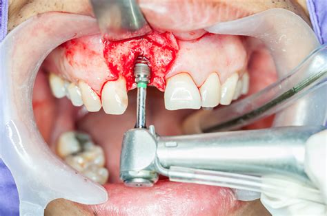 bone graft surgery dental