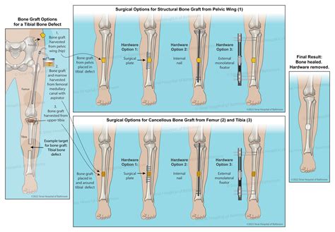 bone graft surgery leg