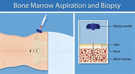 Understanding Bone Marrow Aspiration: What You Need to Know About This Crucial Diagnostic Procedure