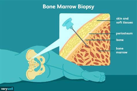 Understanding the Bone Marrow Test: What to Expect and Why It's Done
