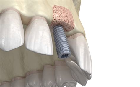 Bone Replacement For Dental Implants