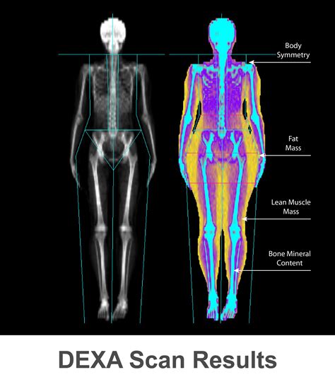 Understanding the Bone Scan Test: What to Expect and Why It's Done