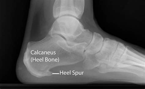 Heel Pain Relief: Understanding Bone Spur on Heel Symptoms