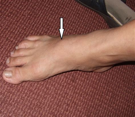 bony swelling in foot