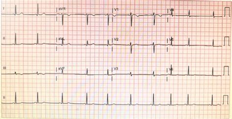 borderline ecg sinus rhythm