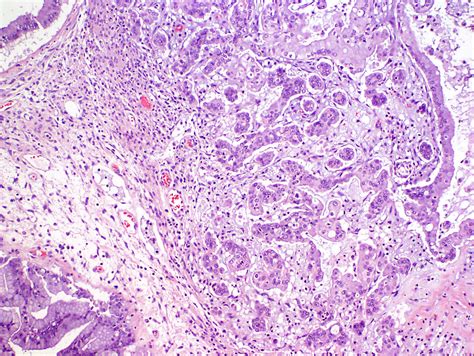 borderline mucinous tumor treatment