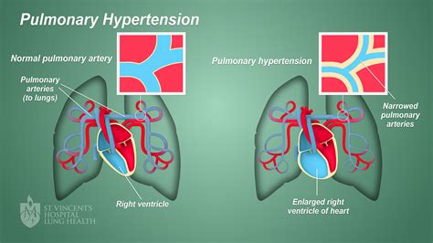 borderline pulmonary hypertension