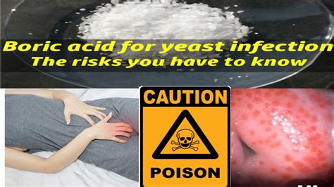 boric acid yeast infection dosage