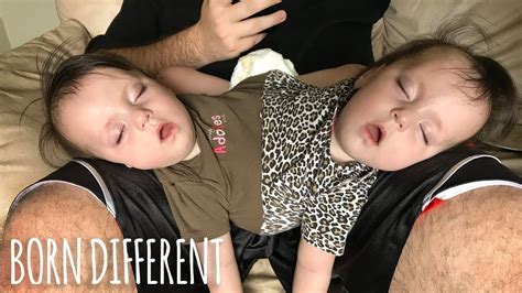 born different conjoined twins