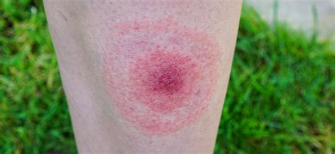 Borreliose Symptome, Behandlung & Übertragung Medizin Intersana