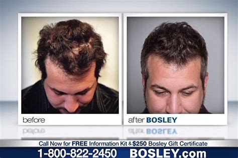 Bosley Hair Transplant Before and After 12 Month Timelapse YouTube