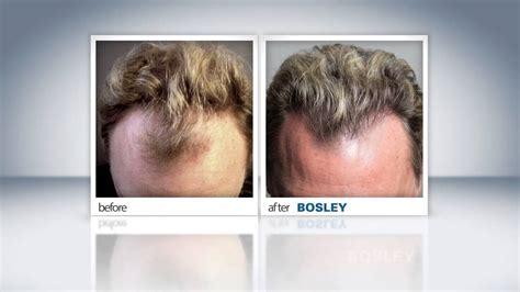 Bosley Hair Transplant Before and After 12 Month Timelapse YouTube