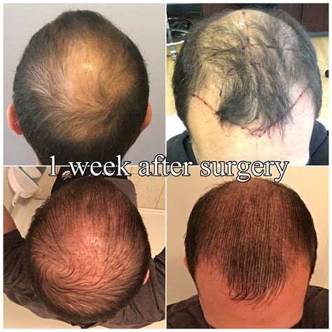 FUE hair transplant before & after Yelp