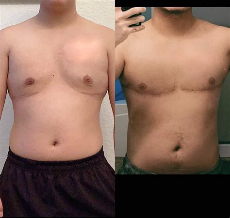 Watch Botched Ftm Top Surgery