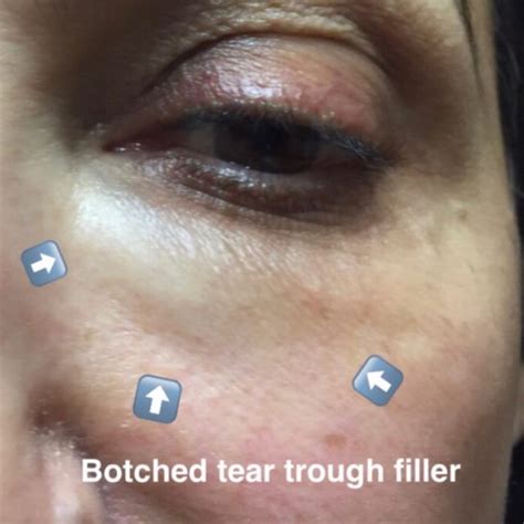 Botched Tear Trough Filler: Causes and Fixes