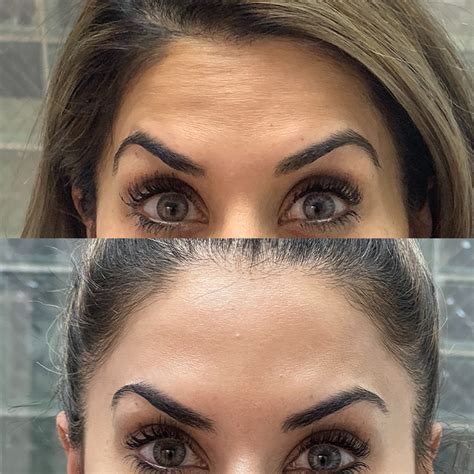 botox and botulism connection