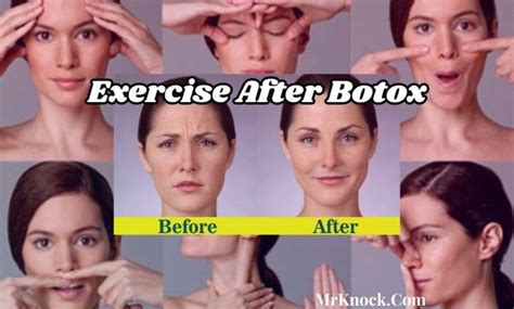 botox and exercise