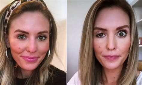 botox brow lift gone wrong