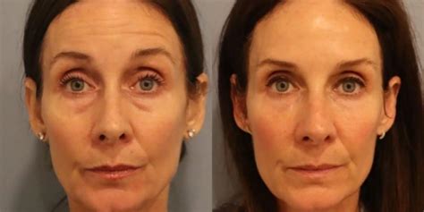 botox cherry hill nj