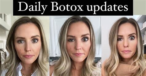 botox face side effects