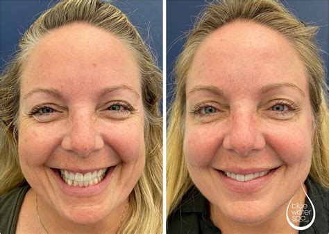 botox for crow's feet cost