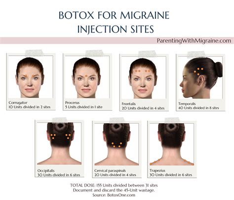 botox for migraine protocol