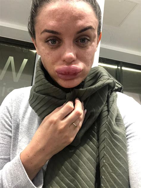 botox gone wrong lips