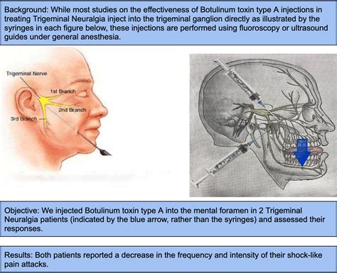 botox injection for trigeminal neuralgia