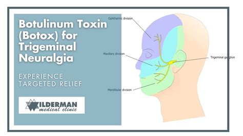 botox injection sites for trigeminal neuralgia