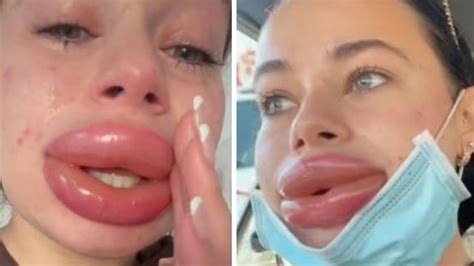 Botox Lip Disasters