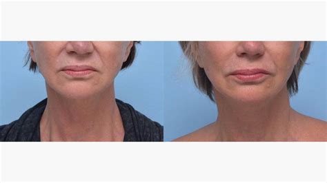 Botox Smile Lines: Breakthrough Solution Unveiled