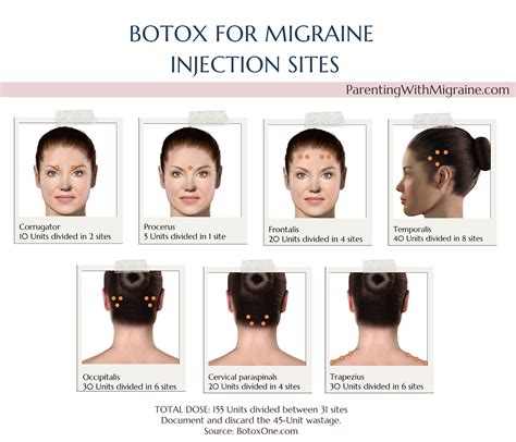 botox treatment for migraines reviews