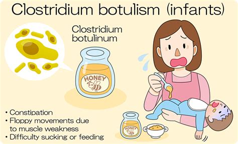 botulism in infants caused by