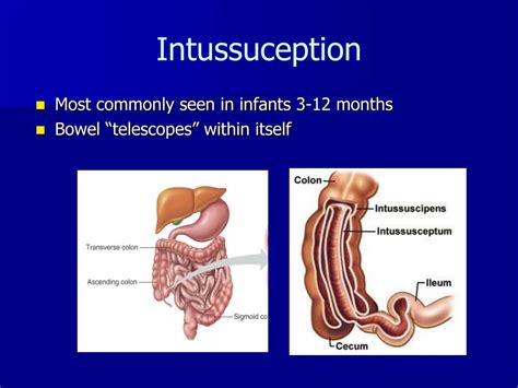 Bowel Telescopes Into Itself