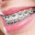 braces colors for adults