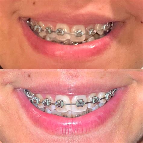 Braces Adjustment Every 8 Weeks