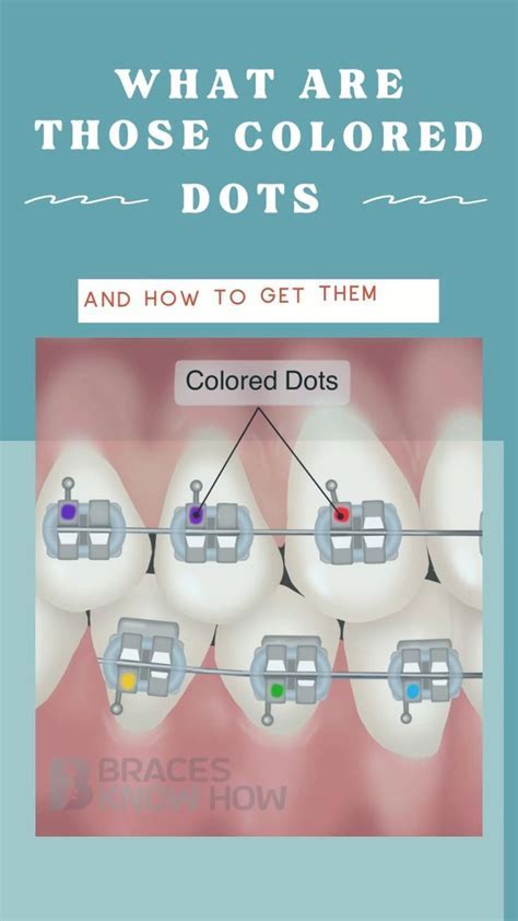 Braces Alignment Dots