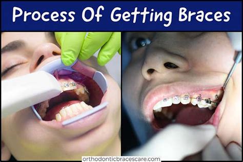 Braces Appointment Steps