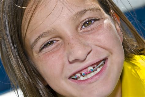 Braces At Age 8