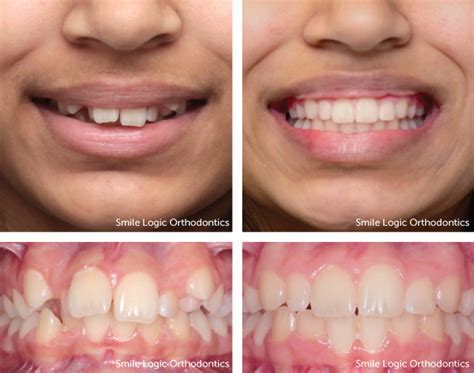 Braces Before And After Deep Bite