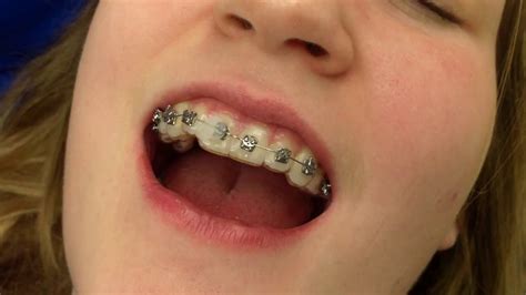 Braces Bracket Fell Off Cost