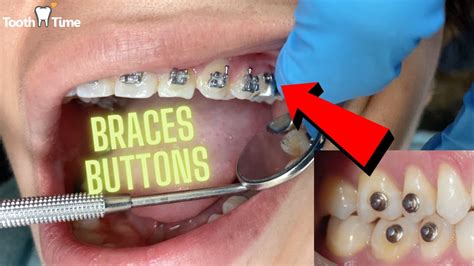 Braces Buttons Placement