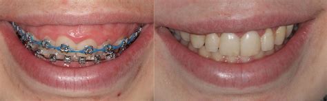Braces Causing Gum Swelling