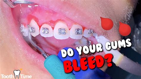 Braces Causing Gums To Bleed